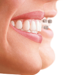 How do Invisalign Clear Braces work?