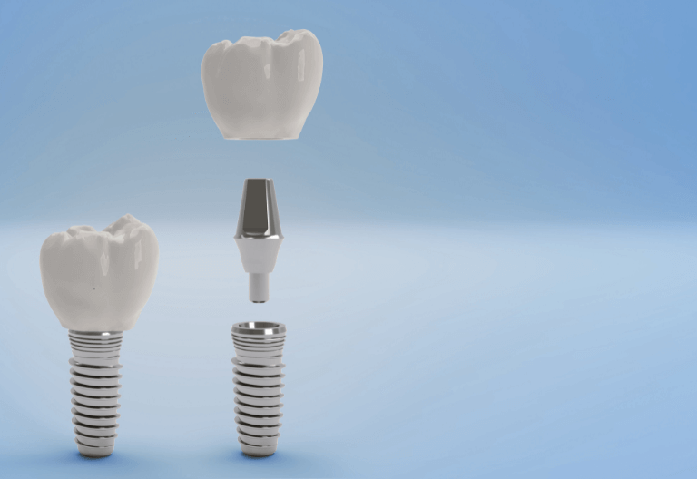 What Dental implants look like (Nottingham)