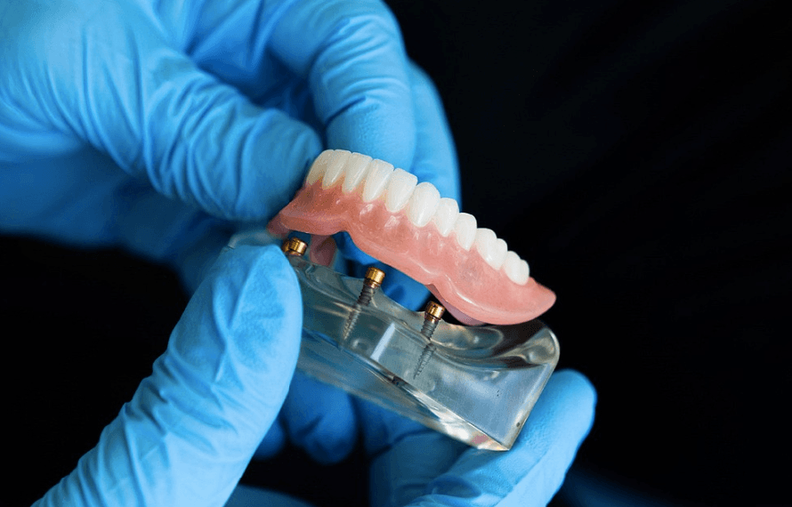 A dentist holding a denture model, showing the posts.