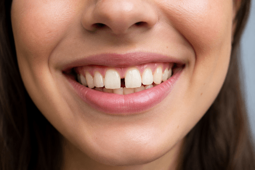 Close-up of a person smiling, showing their gap teeth.