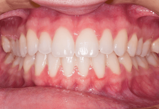 Close-up view of a person’s front teeth after a dental implant procedure.