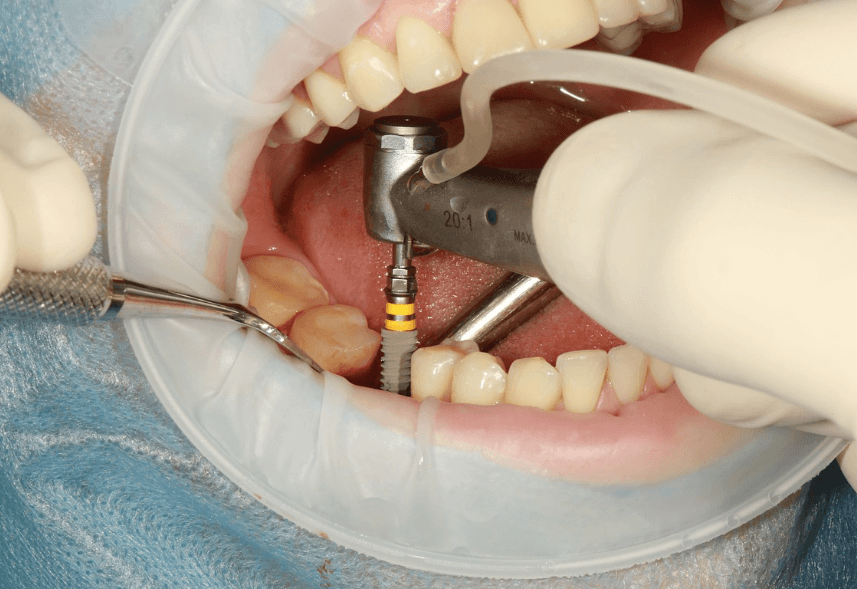 Close-up of a titanium root placement during a dental implant procedure.
