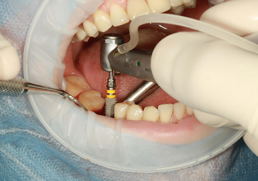 A dentist placing a dental implant in a person’s lower jaw. 