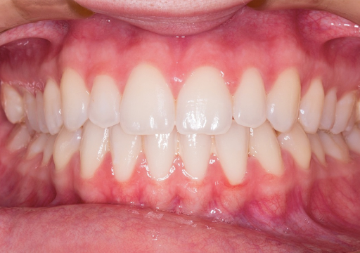 Close-up view of a person’s lower teeth after dental implant surgery. 