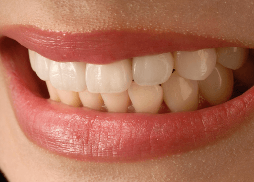 Close-up of a person smiling, showing what veneers can achieve cosmetically.