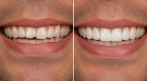 Before and after results of a person’s teeth after getting 3D printed veneers.