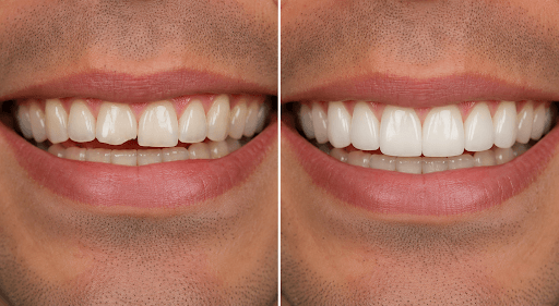 Before and after results of a person’s teeth after getting 3D printed veneers.